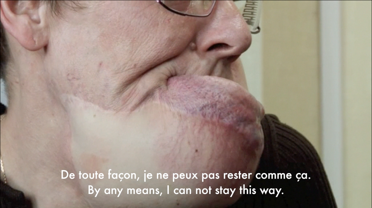 Ms B. speaking before her facial allotransplant